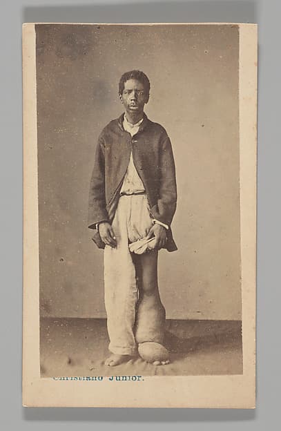 [Studio Portrait: Man Standing with Swollen Leg and Foot Caused by Elephantiasis, Brazil], by Christiano Junior