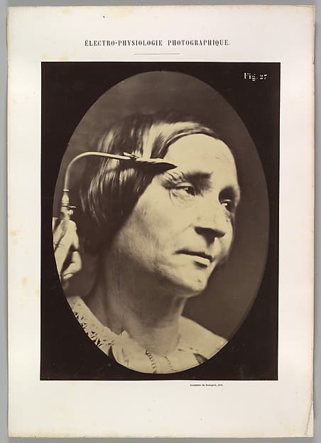 Figure 27: Expression proportionally more pained, by Guillaume-Benjamin-Amand Duchenne de Boulogne