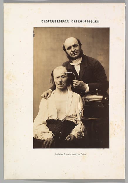 Faradisation du muscle frontal, by Guillaume-Benjamin-Amand Duchenne de Boulogne