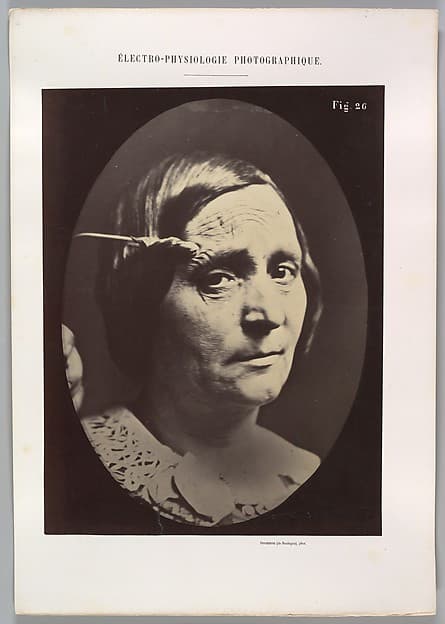 Figure 26: Expression of painful attention and attention, attentive gaze., by Guillaume-Benjamin-Amand Duchenne de Boulogne