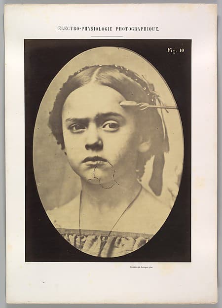 Figure 10: Showing the expressive lines of m. frontalis in a young girl, by Guillaume-Benjamin-Amand Duchenne de Boulogne