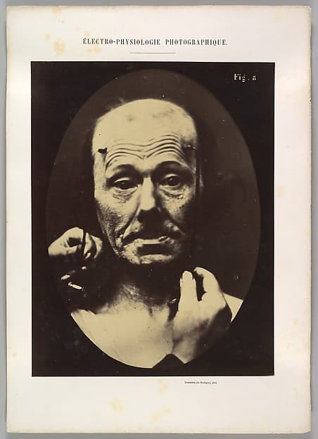Figure 8: Contraction of the right m. frontalis., by Guillaume-Benjamin-Amand Duchenne de Boulogne