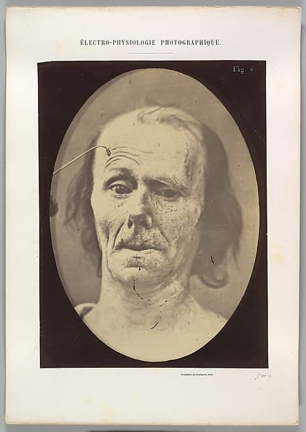 Figure 9: A study of m. frontalis in maximum contraction, by Guillaume-Benjamin-Amand Duchenne de Boulogne