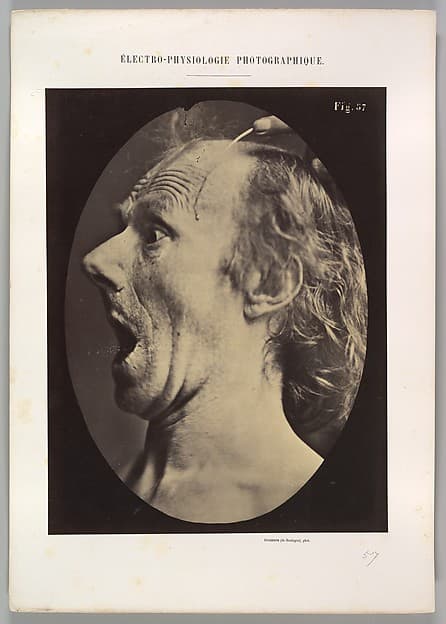Figure 57: Astonishment, stupefaction, amazement, by Guillaume-Benjamin-Amand Duchenne de Boulogne