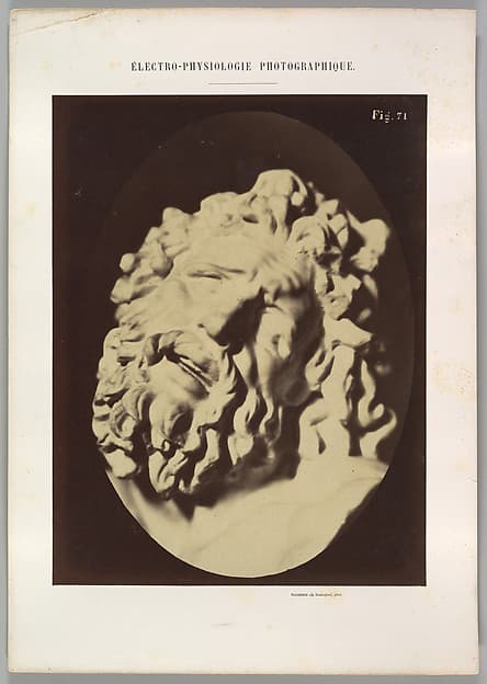 Figure 71: Same head as in Plate 70, by Guillaume-Benjamin-Amand Duchenne de Boulogne